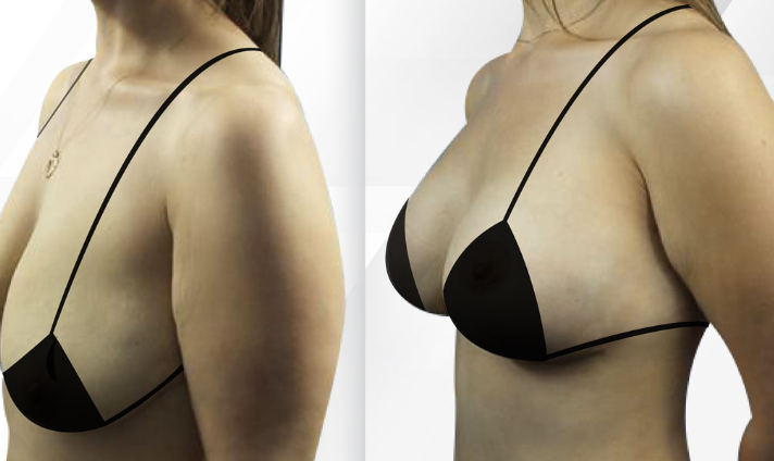 The Breast augmentation Miami can provide excellent results, improving the appearance of the breasts