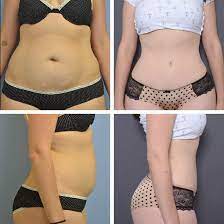 Get the Best Results from Abdominoplasty in Miami